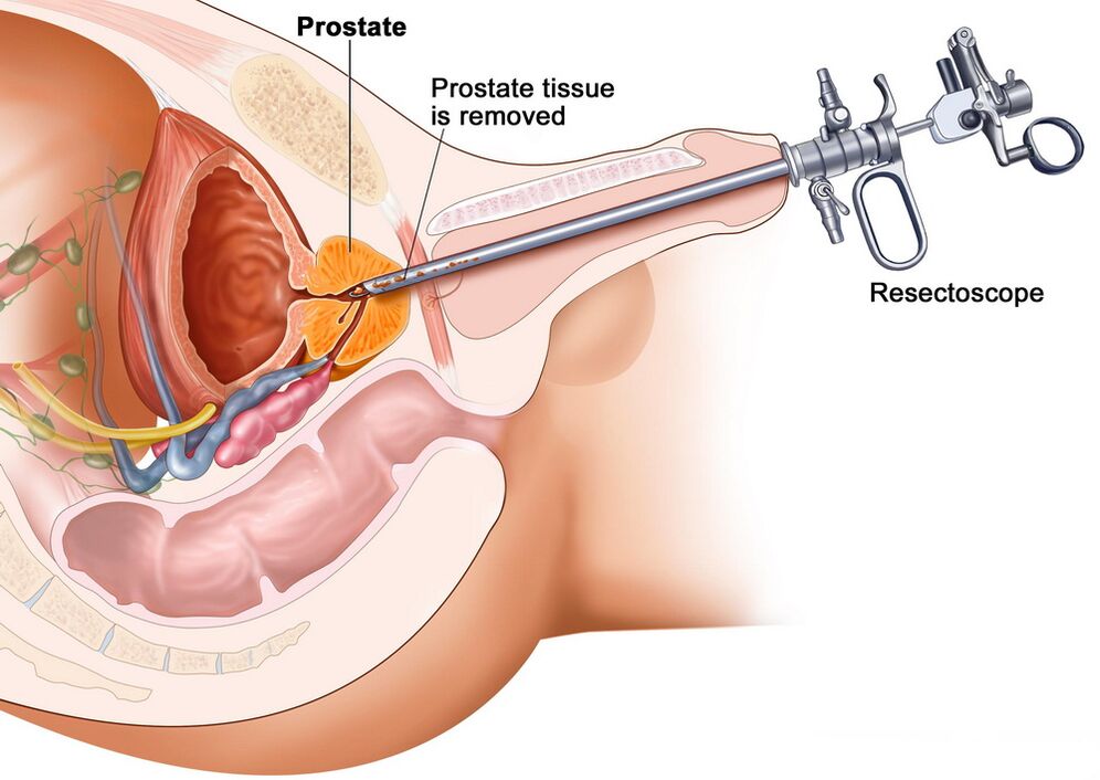 Odběr tkáně prostaty pro přesnou diagnózu prostatitidy