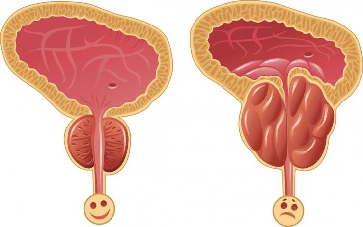 Zdravá prostata a prostatitida